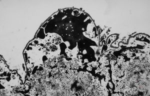 M,63y. | dystrophic calcification in plexus chorioides